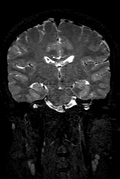 Cerebral arteriovenous malformation at posterior body of corpus callosum (Radiopaedia 74111-84925 Coronal T2 97).jpg
