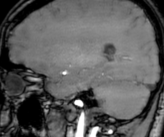 Cerebral arteriovenous malformation at posterior body of corpus callosum (Radiopaedia 74111-84925 J 272).jpg