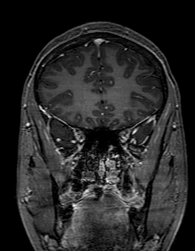 Cerebral arteriovenous malformation at posterior body of corpus callosum (Radiopaedia 74111-84925 K 95).jpg