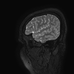 Cerebral arteriovenous malformation at posterior body of corpus callosum (Radiopaedia 74111-84925 Sagittal T2 123).jpg