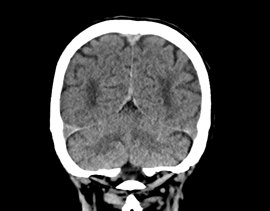 File:Cerebral arteriovenous malformation with lobar hemorrhage (Radiopaedia 44725-48510 Coronal non-contrast 37).png