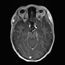 Cerebral cavernous venous malformation (Radiopaedia 70008-80021 Axial T1 C+ 26).jpg