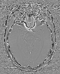 Cerebral cavernous venous malformation (Radiopaedia 70008-80021 G 30).jpg