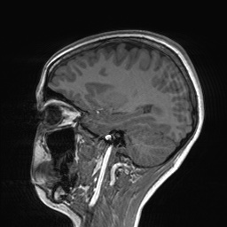 File:Cerebral cavernous venous malformation (Radiopaedia 70008-80021 Sagittal T1 24).jpg
