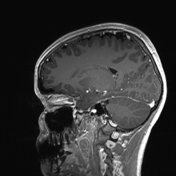 Cerebral cavernous venous malformation (Radiopaedia 70008-80021 Sagittal T1 C+ 45).jpg