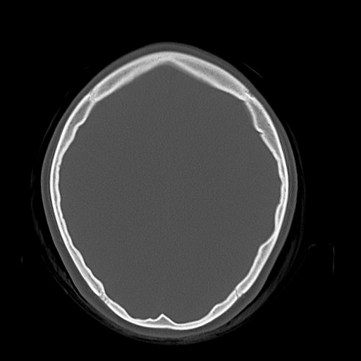 Cerebral cavernous venous malformation (Radiopaedia 70008-80022 Axial bone window 35).jpg