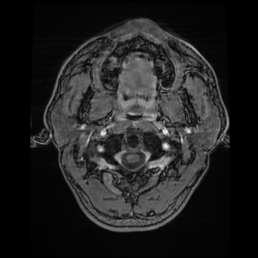 Cerebral cavernous venous malformation (Zabramski type II) (Radiopaedia 85511-101198 Axial T1 C+ fat sat 84).jpg