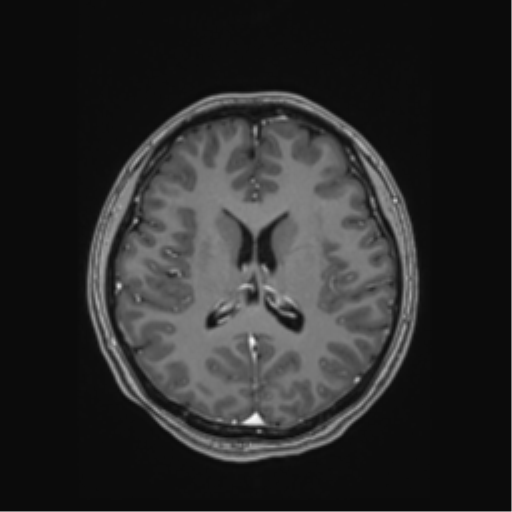 File:Cerebral cavernous venous malformations (Radiopaedia 48117-52946 Axial T1 C+ 36).png
