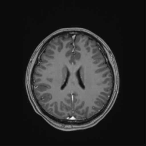 Cerebral cavernous venous malformations (Radiopaedia 48117-52946 Axial T1 C+ 39).png