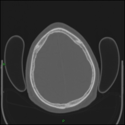 Cerebral contusions (Radiopaedia 33868-35039 Axial bone window 177).jpg