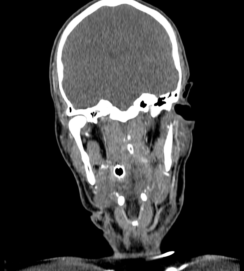 Cerebral edema in an overdose patient (Radiopaedia 72005-82539 B 50).jpg