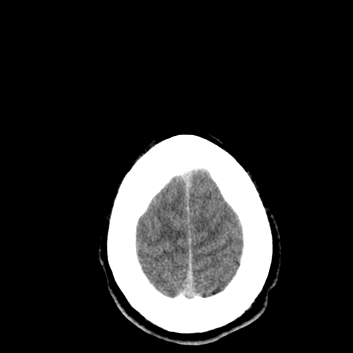 File:Cerebral hemorrhagic contusions- temporal evolution (Radiopaedia 40224-42753 Axial non-contrast 30).png