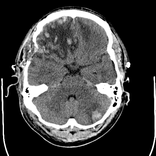File:Cerebral hemorrhagic contusions- temporal evolution (Radiopaedia 40224-42755 AXIAL THICK 9).png