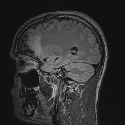 File:Cerebral hemorrhagic contusions- temporal evolution (Radiopaedia 40224-42757 Sagittal T1 54).png