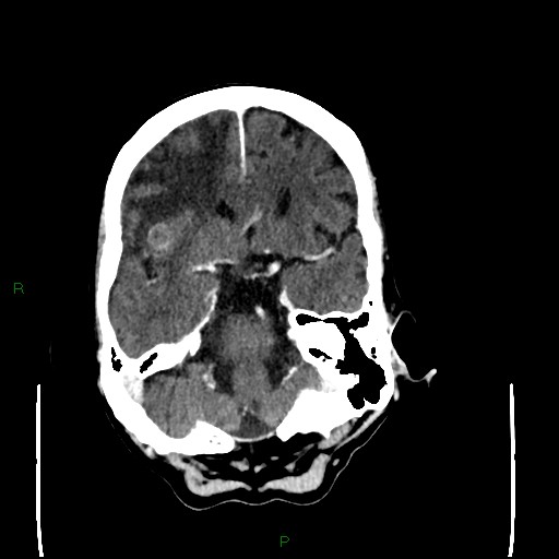 Cerebral metastases - breast primary (Radiopaedia 77653-89857 Axial C+ delayed 38).jpg