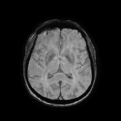 Cerebral metastases - melanoma (Radiopaedia 80972-94522 Axial SWI 53).jpg