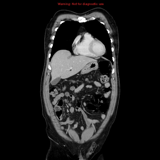 Cerebral metastasis - colorectal carcinoma (Radiopaedia 8581-83548 A 24).jpg
