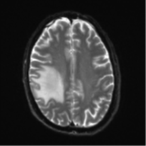 Cerebral metastasis - melanoma (Radiopaedia 54718-60954 Axial DWI 21).png