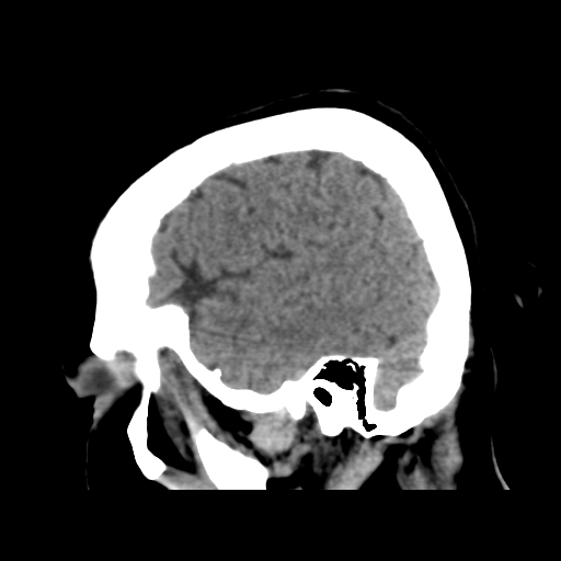 Cerebral metastasis to basal ganglia (Radiopaedia 81568-95412 E 48).png