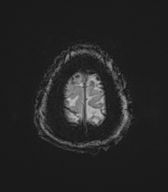 Cerebral metastasis to basal ganglia (Radiopaedia 81568-95413 Axial SWI 84).png
