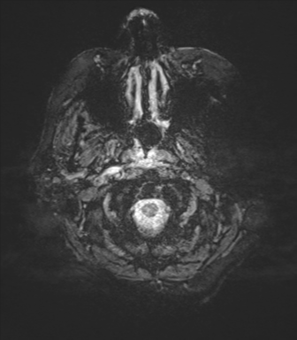 Cerebral metastasis to basal ganglia (Radiopaedia 81568-95413 Axial SWI magnitude 1).png