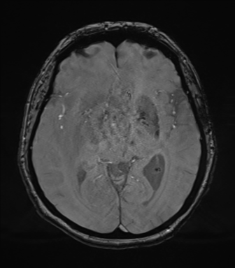 Cerebral metastasis to basal ganglia (Radiopaedia 81568-95413 Axial SWI magnitude 39).png
