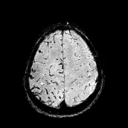 Cerebral parenchymal arteriovenous malformation (Radiopaedia 27280-27456 Axial SWI 101).jpg