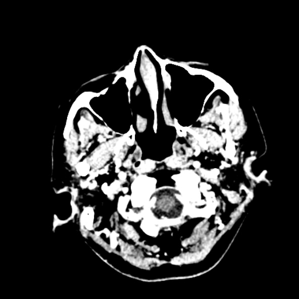 Cerebral ring enhancing lesions - cerebral metastases (Radiopaedia 44922-48818 B 22).jpg