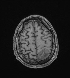 Cerebral toxoplasmosis (Radiopaedia 43956-47461 Axial T1 67).jpg