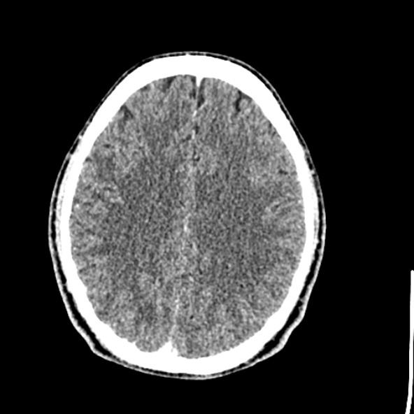 Cerebral toxoplasmosis (Radiopaedia 53993-60131 Axial C+ delayed 50).jpg