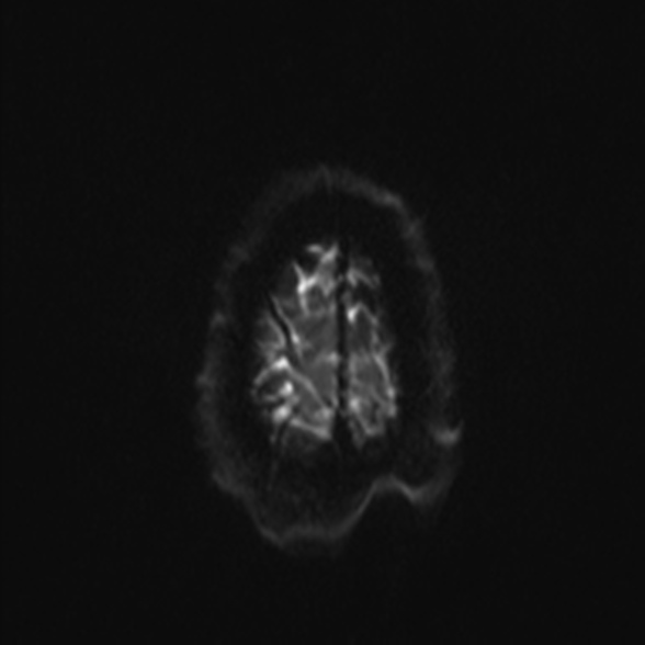 Cerebral toxoplasmosis (Radiopaedia 53993-60132 Axial DWI 25).jpg