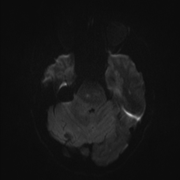 Cerebral toxoplasmosis (Radiopaedia 53993-60132 Axial DWI 35).jpg