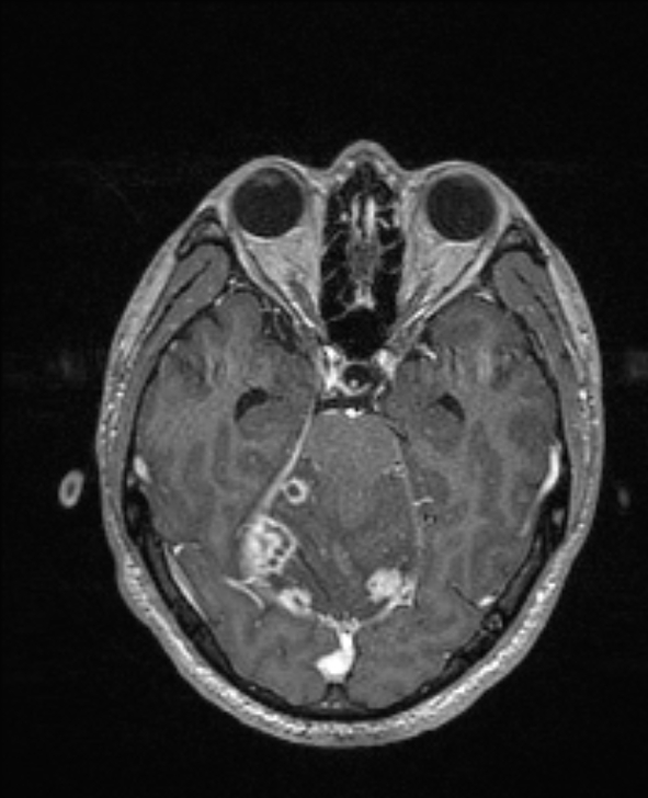 Cerebral toxoplasmosis (Radiopaedia 85779-101597 Axial T1 C+ 59).jpg
