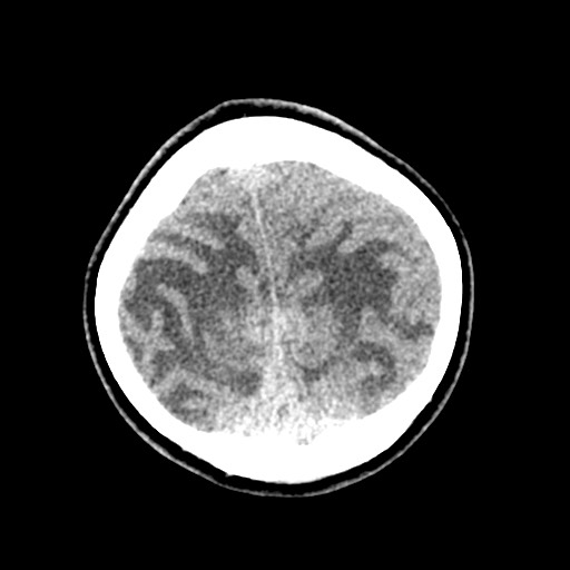 Cerebral tuberculosis with dural sinus invasion (Radiopaedia 60353-68018 Axial non-contrast 53).jpg