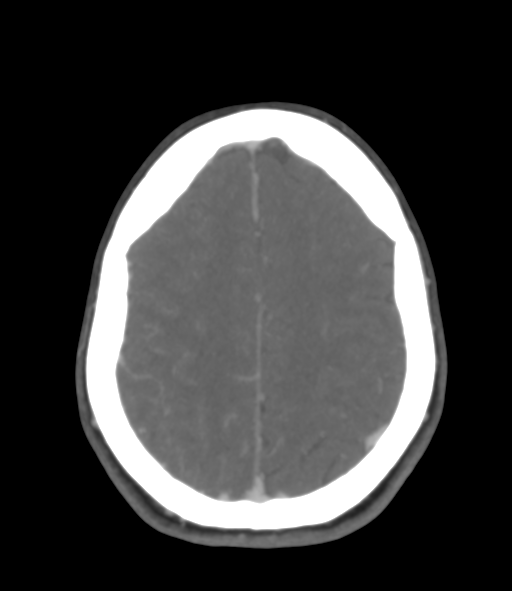 Cerebral venous hemorrhagic infarction (Radiopaedia 38461-40550 Axial MIP VENOGRAM 40).png