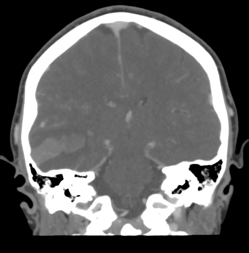 Cerebral venous hemorrhagic infarction (Radiopaedia 38461-40550 Coronal MIP VENOGRAM 35).png