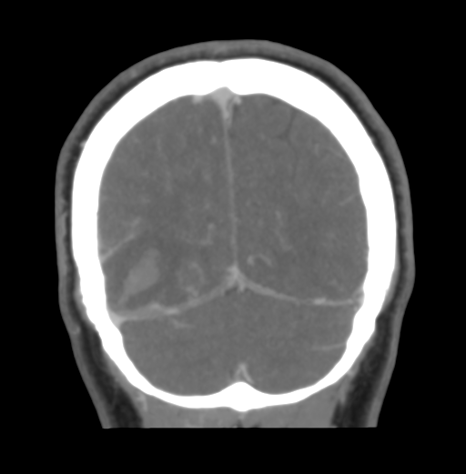 Cerebral venous hemorrhagic infarction (Radiopaedia 38461-40550 Coronal MIP VENOGRAM 49).png
