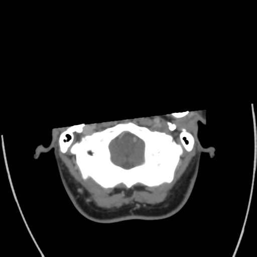 File:Cerebral venous infarct related to dural venous sinus thromboses (Radiopaedia 35292-36804 Axial C+ delayed 7).png