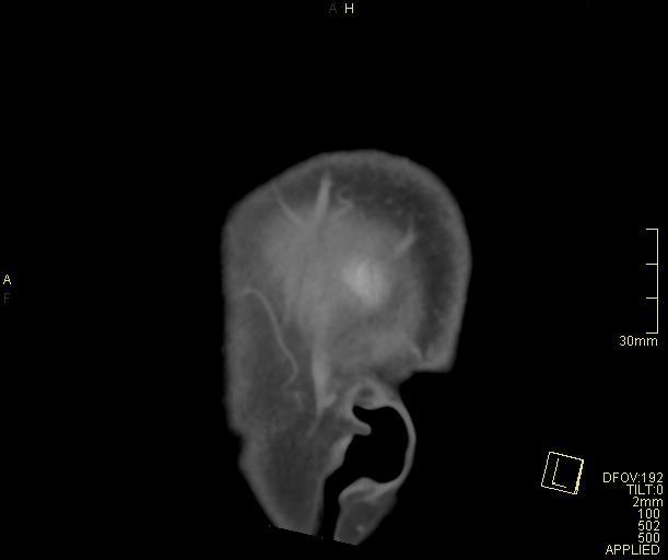 Cerebral venous sinus thrombosis (Radiopaedia 91329-108965 Sagittal venogram 4).jpg