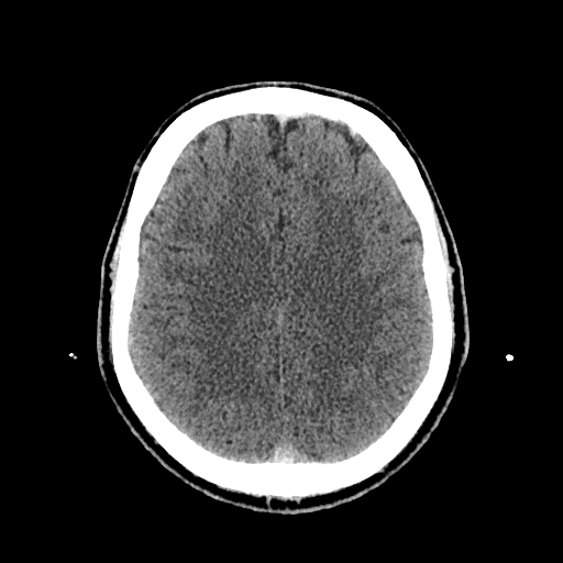 File:Cerebral venous thrombosis (CVT) (Radiopaedia 77524-89685 Axial non-contrast 33).jpg