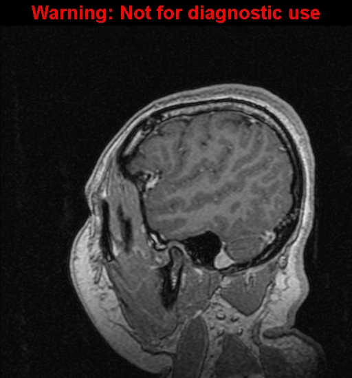 Cerebral venous thrombosis (Radiopaedia 37224-39208 Sagittal T1 C+ 126).jpg