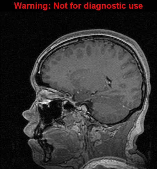 Cerebral venous thrombosis (Radiopaedia 37224-39208 Sagittal T1 C+ 58).jpg