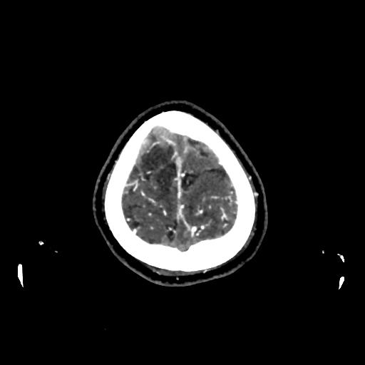 File:Cerebral venous thrombosis - hemorrhagic venous infarction (Radiopaedia 87318-103613 Axial 248).jpg