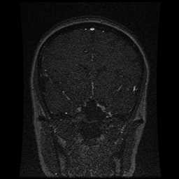 Cerebral venous thrombosis - ulcerative colitis (Radiopaedia 66049-75219 Coronal MRV 76).jpg