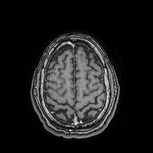 File:Cerebral venous thrombosis with secondary intracranial hypertension (Radiopaedia 89842-106957 Axial T1 C+ 140).jpg