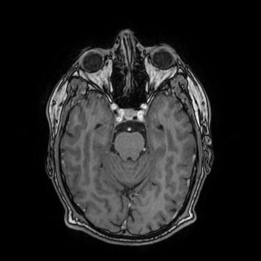 Cerebral venous thrombosis with secondary intracranial hypertension (Radiopaedia 89842-106957 Axial T1 C+ 73).jpg