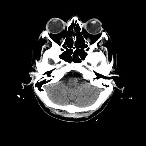 Cerebral venous thrombosis with venous hemorrhagic infarct (Radiopaedia 90354-107660 Axial non-contrast 11).jpg