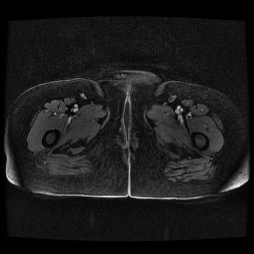 Cervical carcinoma (Radiopaedia 70924-81132 Axial T1 C+ fat sat 100).jpg