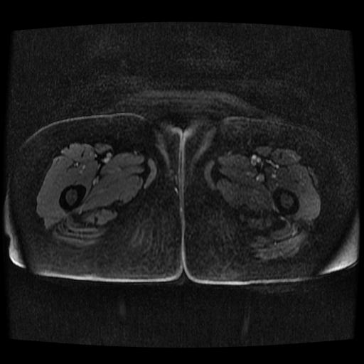 Cervical carcinoma (Radiopaedia 70924-81132 Axial T1 C+ fat sat 93).jpg