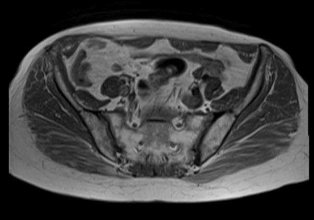 File:Cervical carcinoma (Radiopaedia 88312-104943 Axial T1 7).jpg